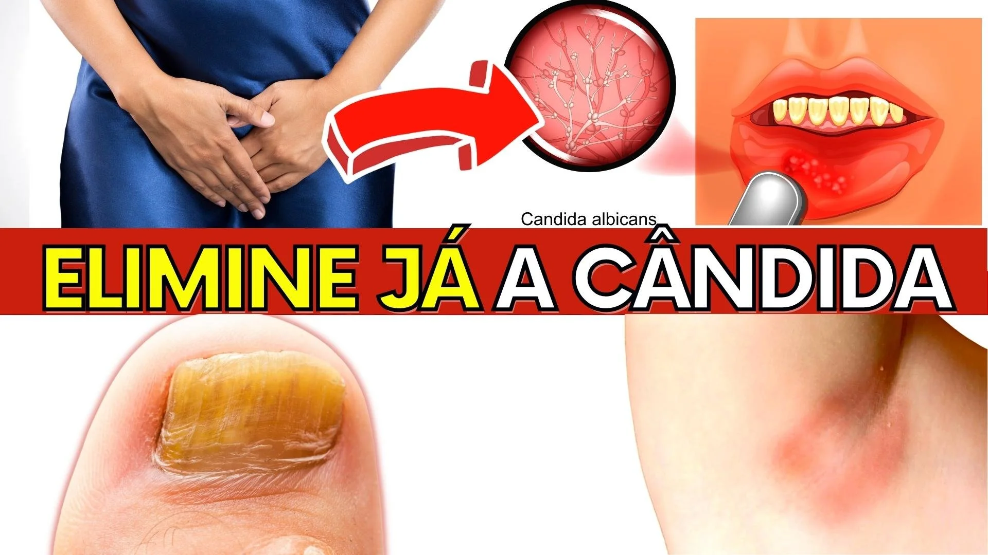 A ÚNICA Maneira de ACABAR COM A CANDIDÍASE para SEMPRE | COMO ELIMINAR A CÂNDIDA NATURALMENTE ...